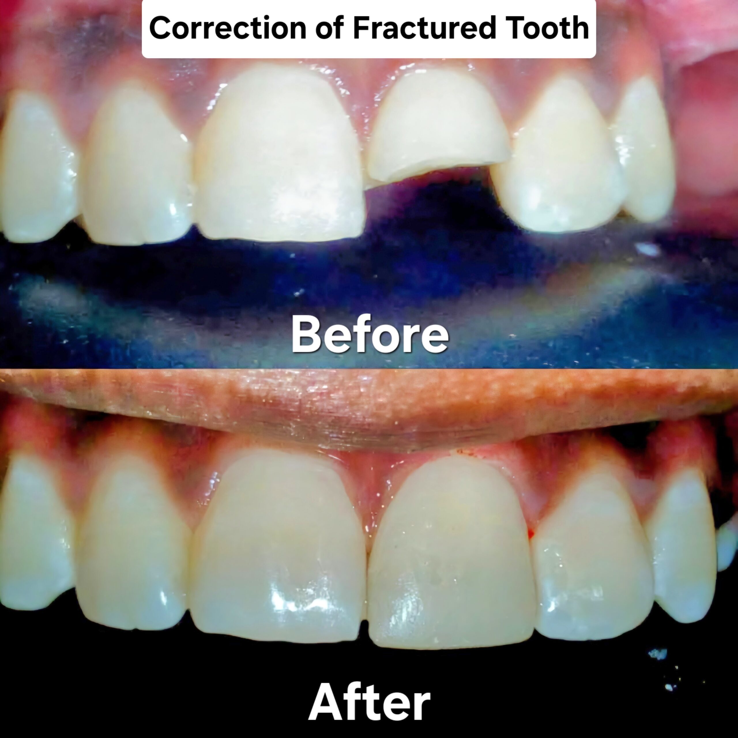 Fractured Tooth Correction