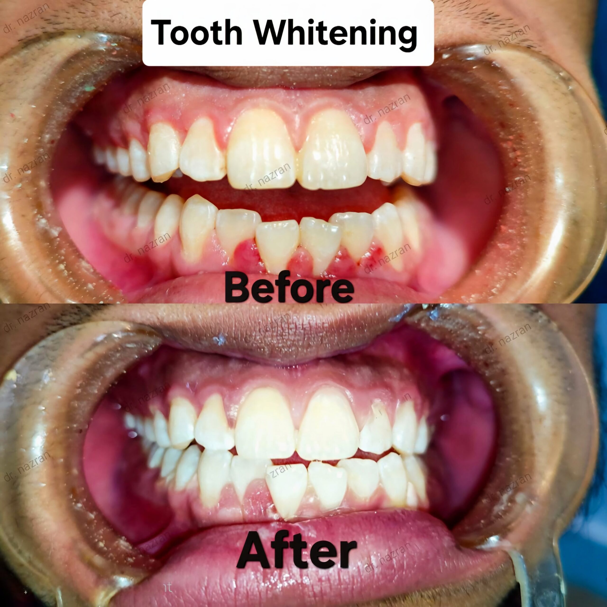 Tooth Whitening